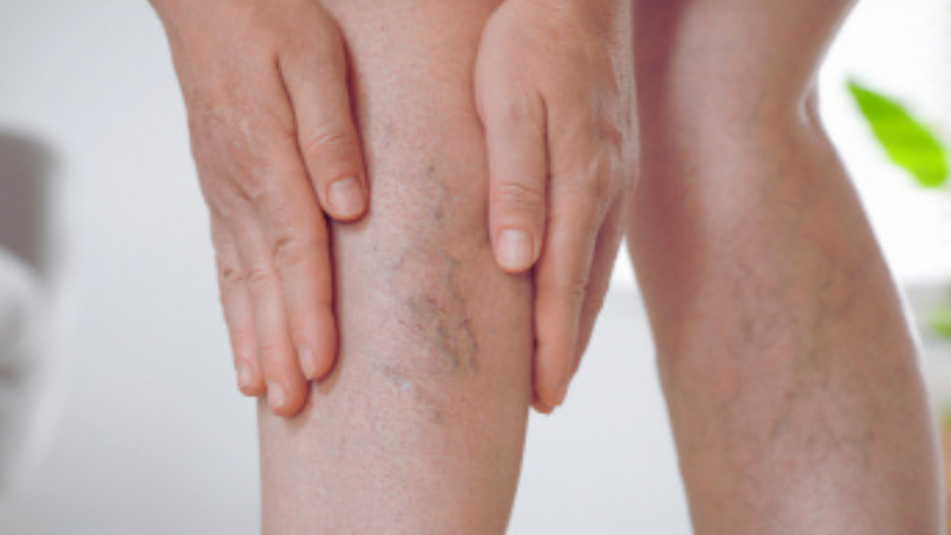 قدرت ۵ مکمل و ویتامین طبیعی در تقویت رگ‌ها و کاهش علائم نارسایی وریدی