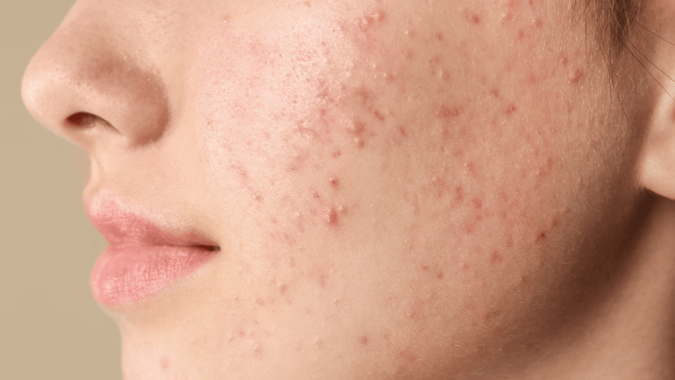 ۱۰ روش سریع و علمی برای از بین بردن جوش در یک شب