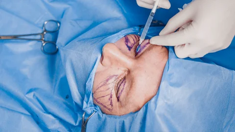 جراحی پلک، صدرنشین عمل‌های زیبایی ۲۰۲۵ شد