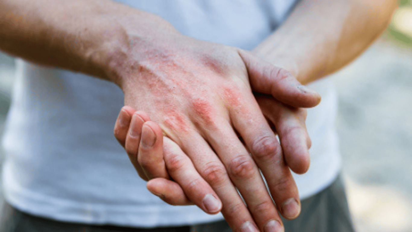 ۱۳ عاملی که می‌توانند درماتیت آتوپیک (اگزمای آتوپیک) را تشدید کنند